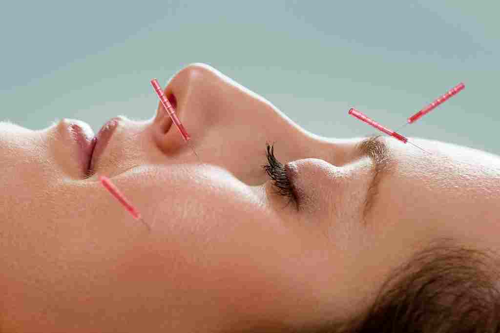 Acupuncture Needles
